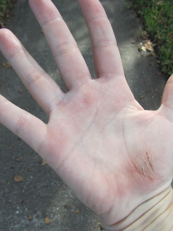 Hand injury