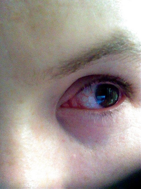 Red eye